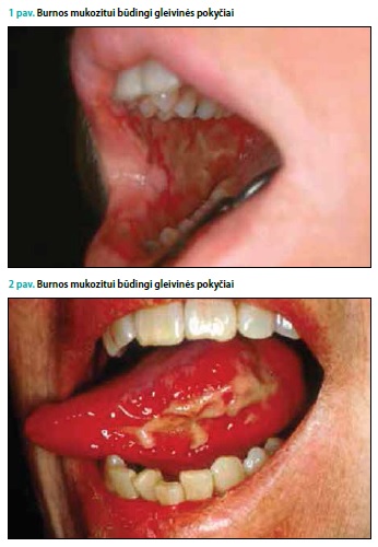 Onkologinių ligų gydymo sukeltas burnos mukozitas ir jo prevencijos bei gydymo galimybės