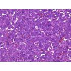Audinio mėginio, galbūt feochromocitomos, nudažyto purpurine spalva, mikroskopinis vaizdas, kuriame matyti tankus tarpusavyje susijusių ląstelių tinklas su mažomis, išsibarsčiusiomis raudonomis ir baltomis sritimis. Vaizdas pabrėžia sudėtingą ląstelių struktūrą.
