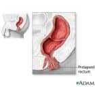 Iliustracija, kurioje pavaizduota vyrų reprodukcinė sistema, daugiausia dėmesio skiriant prostatos liaukai. Išsamus vaizdas išryškina prostatą, esančią žemiau šlapimo pūslės ir aplink šlaplę, šalia tiesiosios žarnos, pabrėžiant jos anatominę reikšmę.