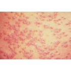 Odos vaizdas stambiu planu, kuriame matomas raudonas, nelygus bėrimas, išsklaidytas visame paviršiuje, panašus į alerginę reakciją arba virusinę infekciją. Fonas yra blyškus odos tonas, kontrastuojantis su rausvomis dėmėmis.