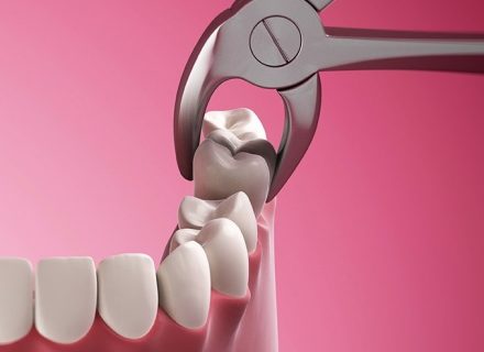 Dantų skausmas – viena nemaloniausių ir labiausiai varginančių problemų