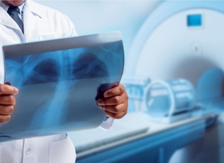 4D technikos reikšmė planuojant plaučių vėžio spindulinį gydymą