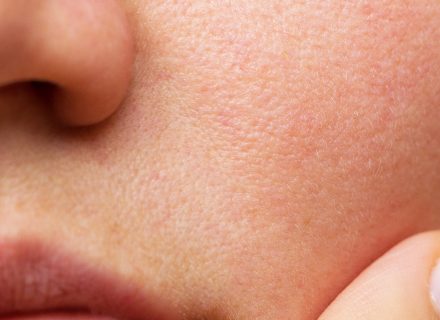 Kaip rūpintis jautria veido oda?