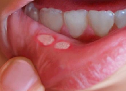 Kaip pagreitinti burnos žaizdelių gijimą ir išvengti pavojingesnių komplikacijų?