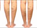 Rodomi keturi kojų komplektai su pastebima venų varikoze. Iš kairės į dešinę išdėstytos nugarėlės rodo venų matomumo skirtumus. Odos tonas yra vienodas visose kojų porose, pabrėžiant laipsnišką būklės progresavimą.
