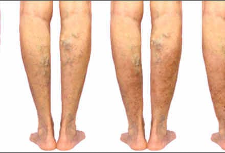 Kas padės apsisaugoti nuo venų varikozės išsivystymo arba jos progresavimo?