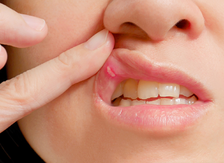 Kaip išvengti pasikartojančio burnos opų susiformavimo?