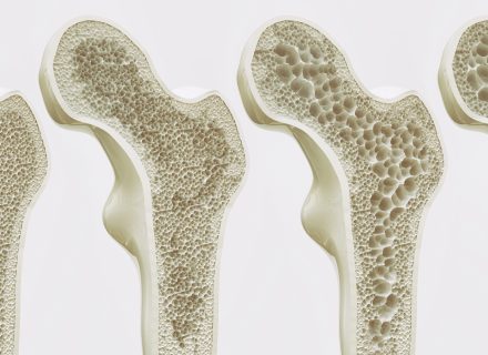Osteoporozės gydymo rekomendacijų apžvalga