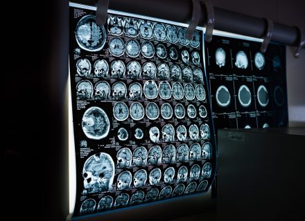 Neurologiniai sutrikimai – kuo gali padėti neurologas?